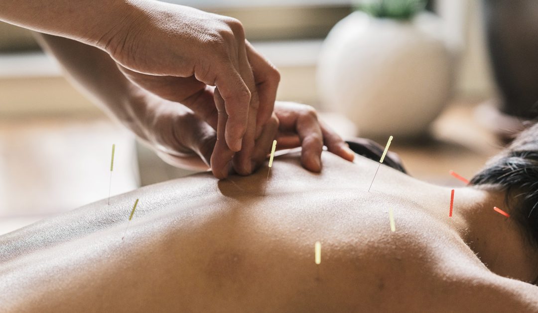 What’s The Difference Between Western Acupuncture And Dry Needling?