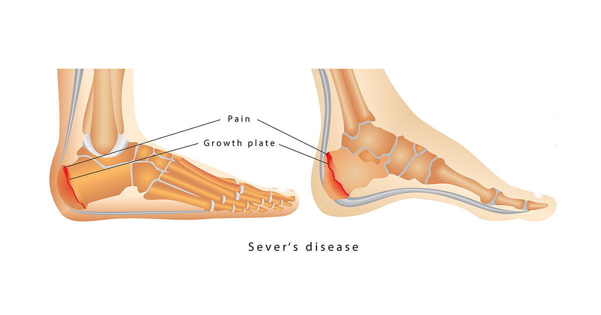 heel growth plate pain