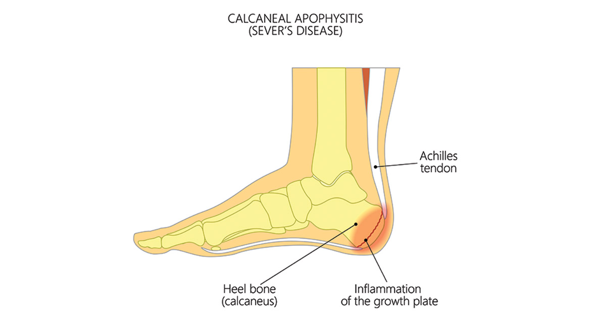 Sever's disease (Calcaneal Apophysitis 