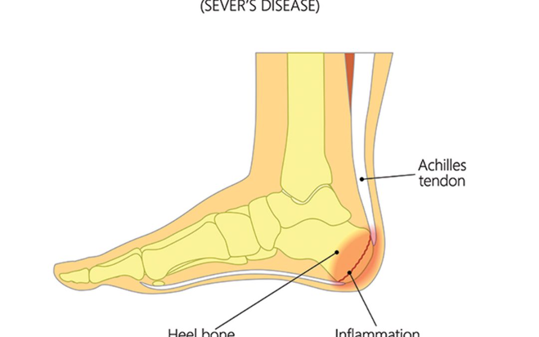 Sever’s disease (Calcaneal Apophysitis)